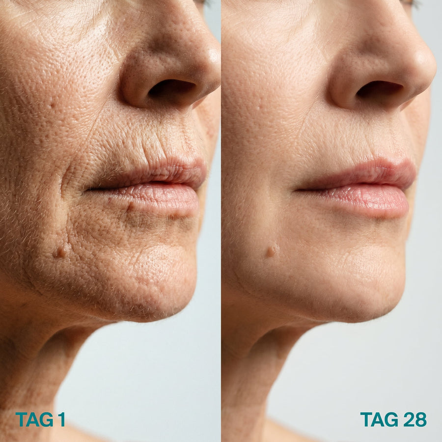 Microneedling gegen Lippenfältchen: Was wirklich gegen Plisseefalten hilft