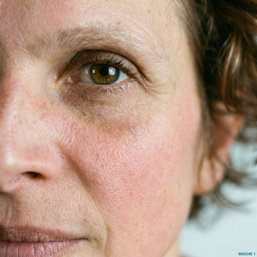 Microneedling Pen Vorher-Nachher: Echte Ergebnisse nach 4, 8 und 12 Wochen