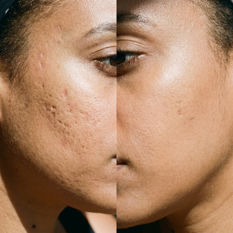 Microneedling bei Aknenarben: Vorher-Nachher und die ehrliche Wahrheit