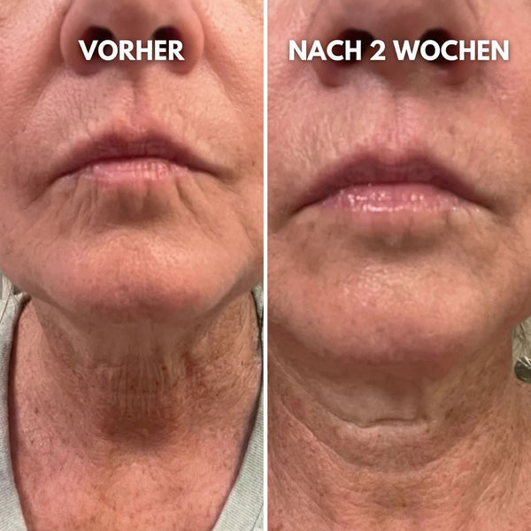 Schmale & faltige Lippenpartie