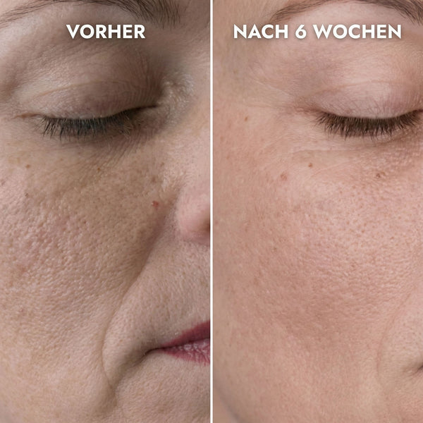Erste Fältchen & Linien