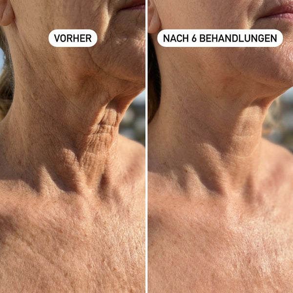 Erschlaffte & faltige Halspartie