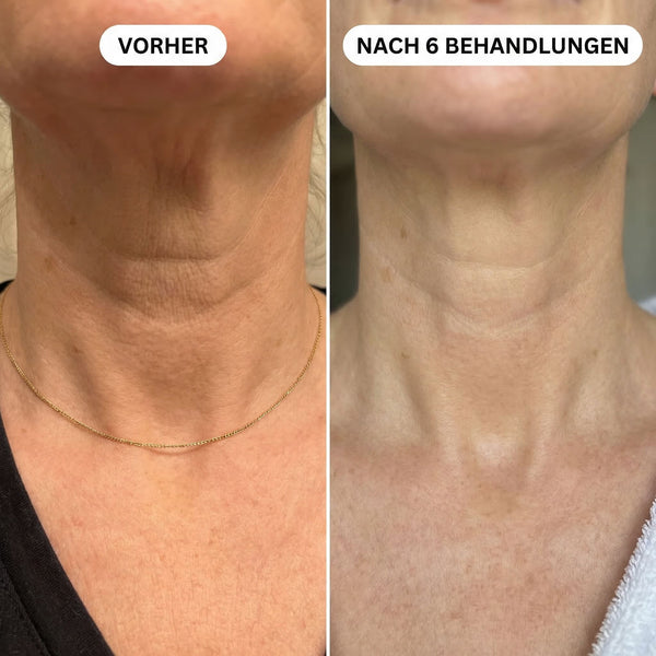 Horizontale Halsfalten