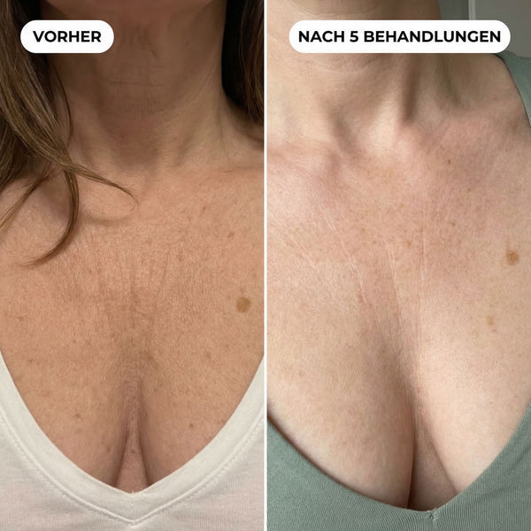 Kreppartige Haut am Dekolleté