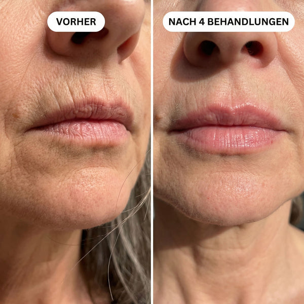 Lippenfältchen & Volumenverlust
