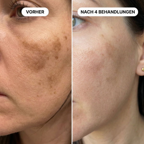 Ungleichmäßiger Teint & Sonnenflecken