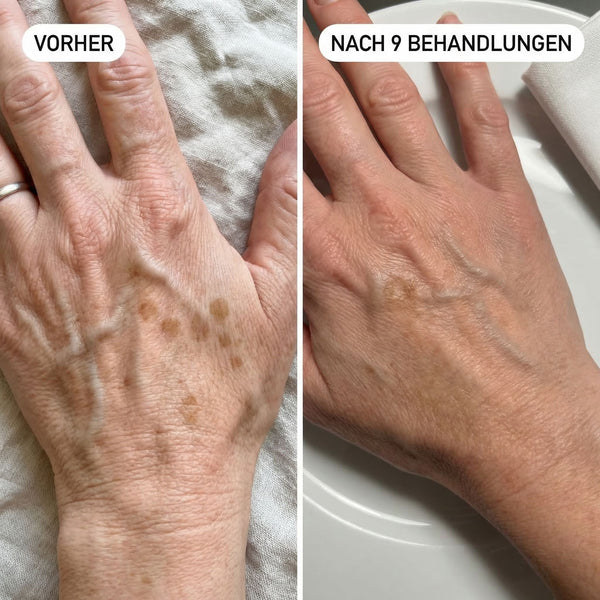 Altersflecken an den Händen