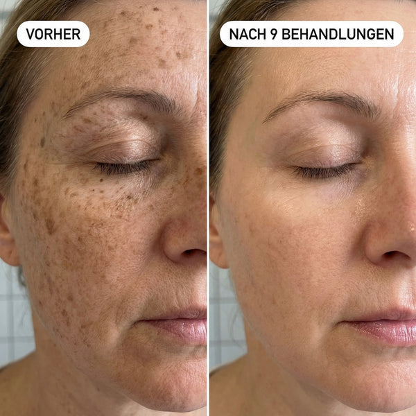 Alters- & Pigmentflecken