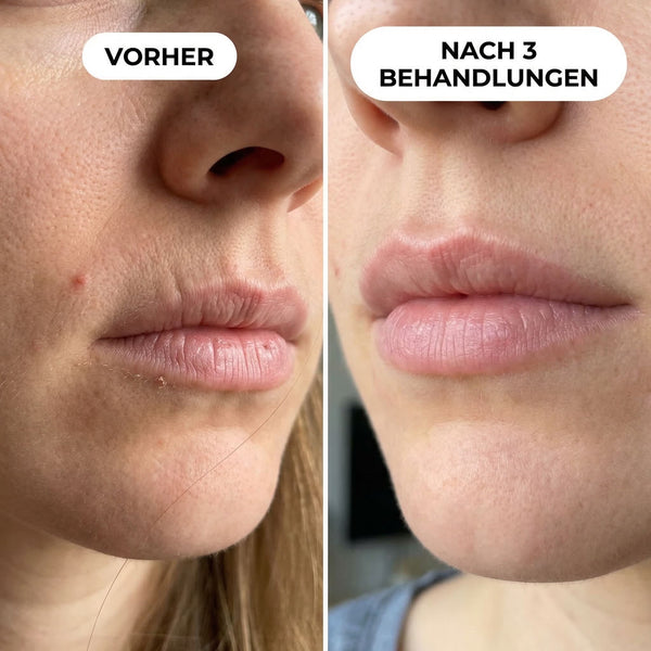 Trockene, konturlose Lippen