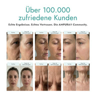 AMPURA Microneedling Erfahrungen und Kundenbewertungen mit Vorher-Nachher-Ergebnissen
