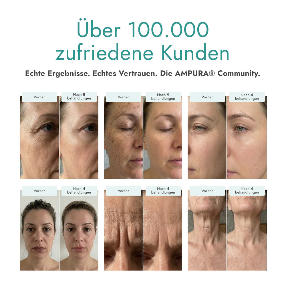 AMPURA Microneedling Erfahrungen und Kundenbewertungen mit Vorher-Nachher-Ergebnissen