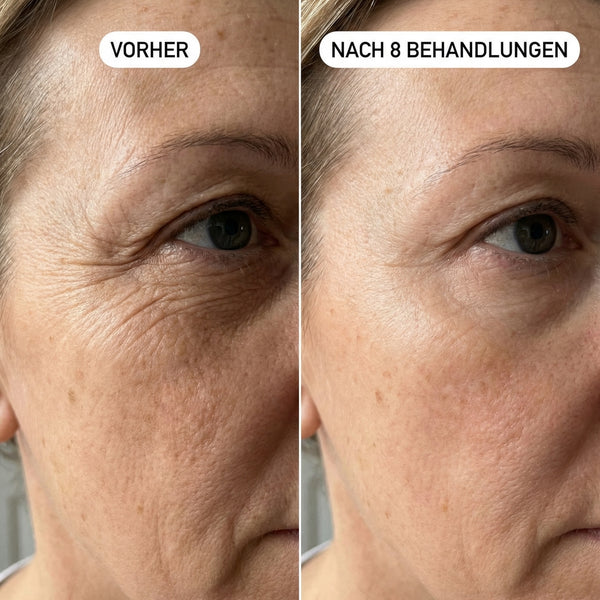 Augenfältchen & Krähenfüße