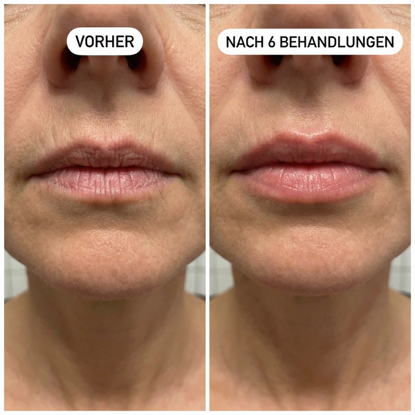 Schmale & faltige Lippenpartie