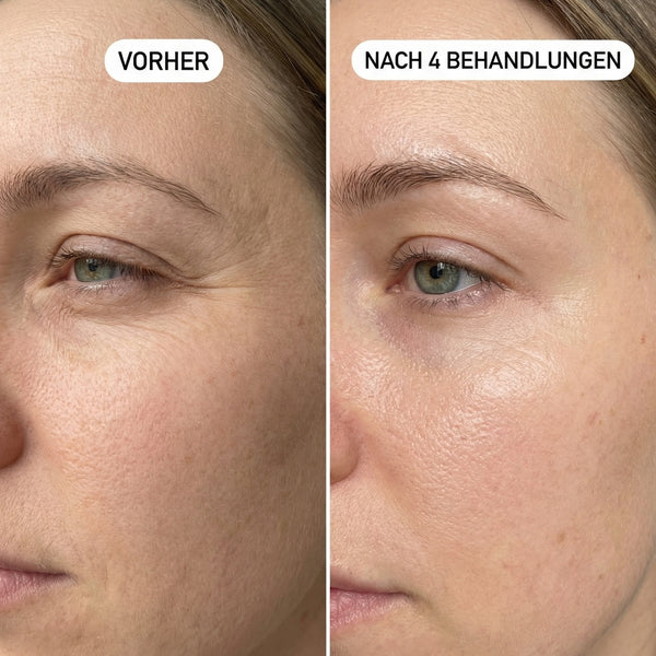 Erste Fältchen & Linien