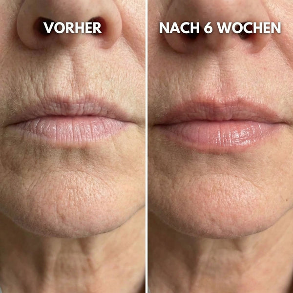 Trockene, konturlose Lippen