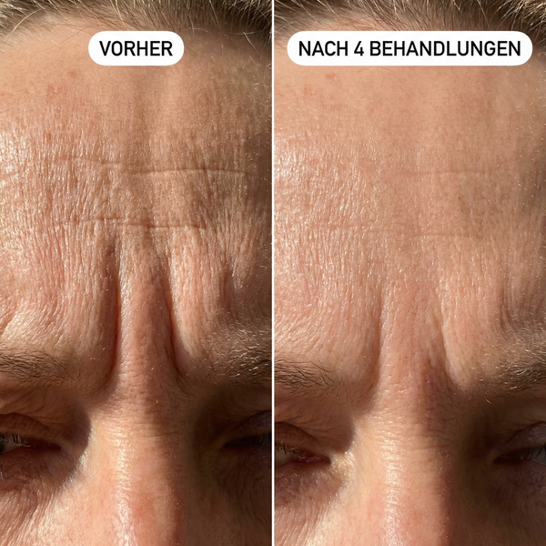 Zornes- & Stirnfalten