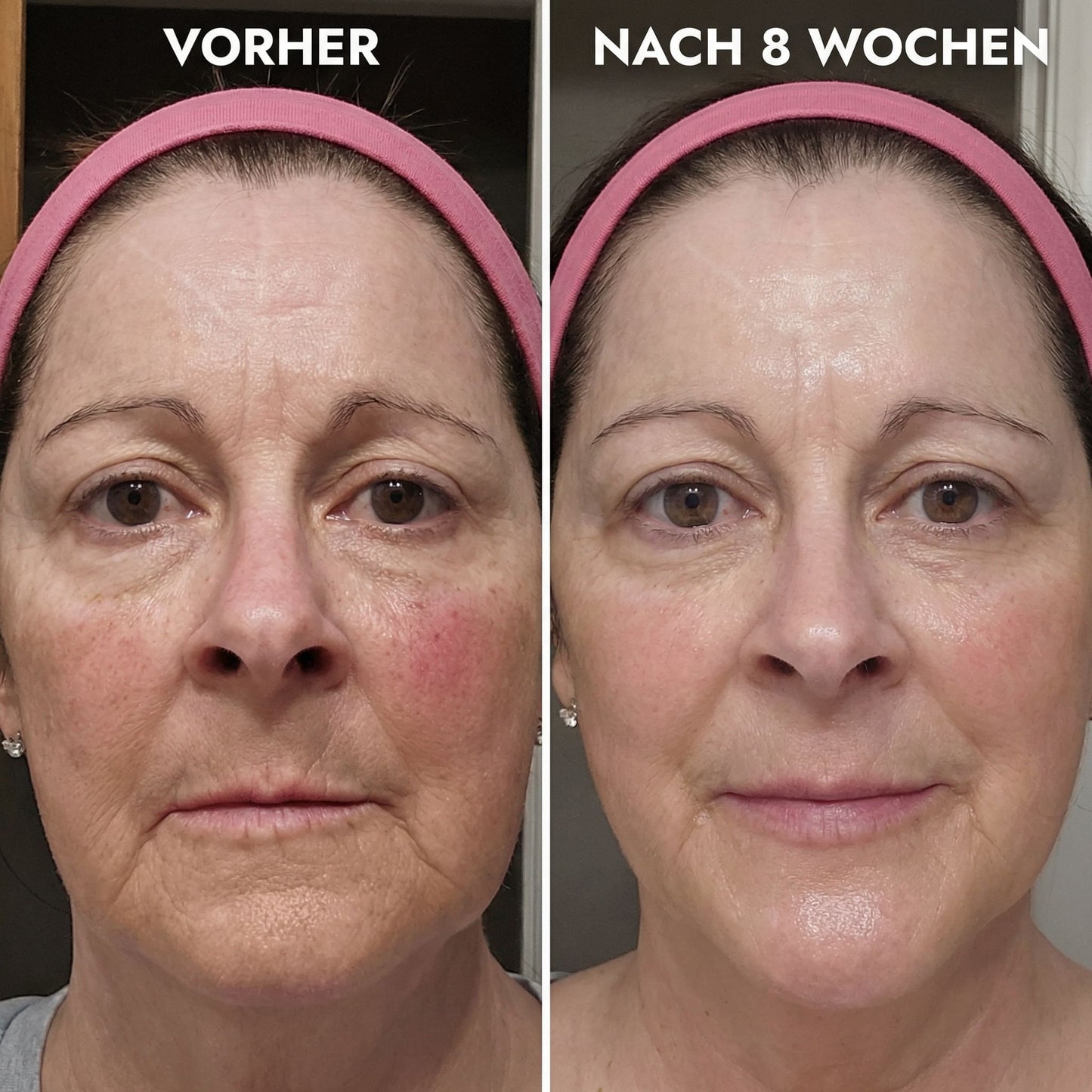 AMPURA® Microneedling Set für Zuhause